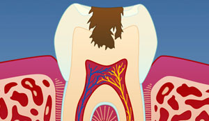 Karies - Hull i tennene