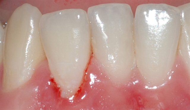 gingivitt Pasient 1 2